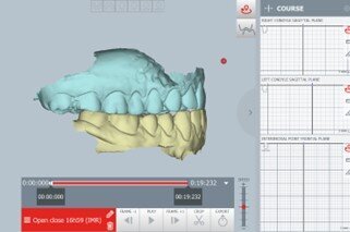 Figg. 9a-9d_La posizione di occlusione abituale, in visione frontale (a) e laterale (b). La posizione terapeutica ottenuta dopo la pianificazione digitale, riposizionando i condili in avanti e in basso e ricentrando la linea mediana, in visione frontale (c) e laterale (d). La posizione terapeutica è stata pianificata in tempo reale durante il check-up diagnostico 
della paziente, con un flusso di lavoro one-day completamente digitale