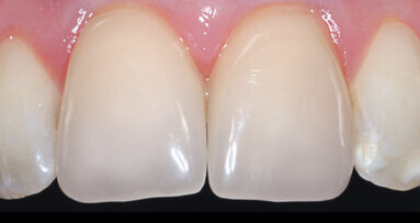 Multichromatická hybridní keramika: Přechody odstínů na stisknutí tlačítka