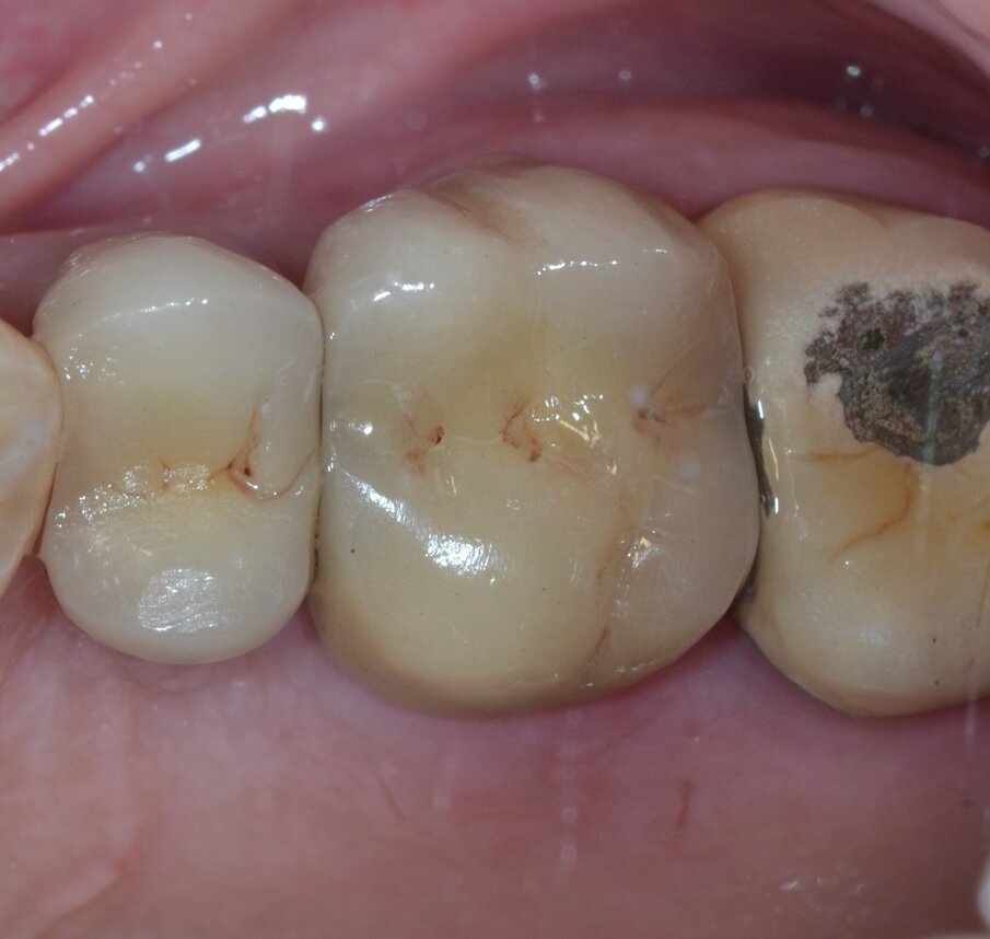 Fig. 10 - Protesizzazione definitiva mediante corona in metallo-ceramica (aspetto occlusale).