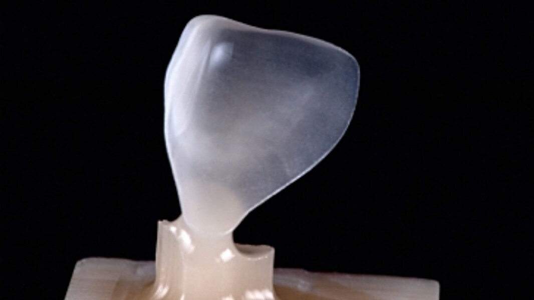 Fig. 3. El resultado de alta precisión tras el proceso de fresado con CEREC MC XL.