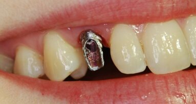 Wpływ czynników estetycznych na wybór metody rehabilitacji implantoprotetycznej