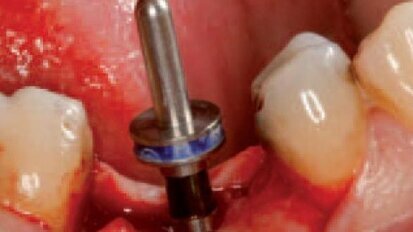 Zastosowanie implantu C1 – opis przypadku