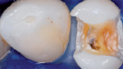 Klinické použití nového zatékavého podkladového materiálu pro přímé a nepřímé výplně