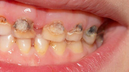 I batteri orali delle madri possono provocare carie nei loro figli