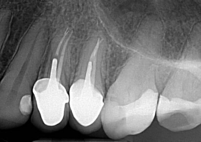 Fig. 2: Radiografia dei ritrattamenti canalari.