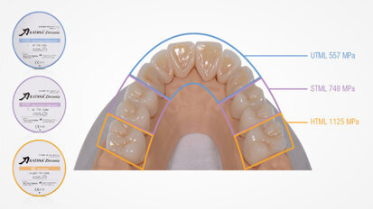 Full-mouth rehabilitation with three different types of KATANA Zirconia