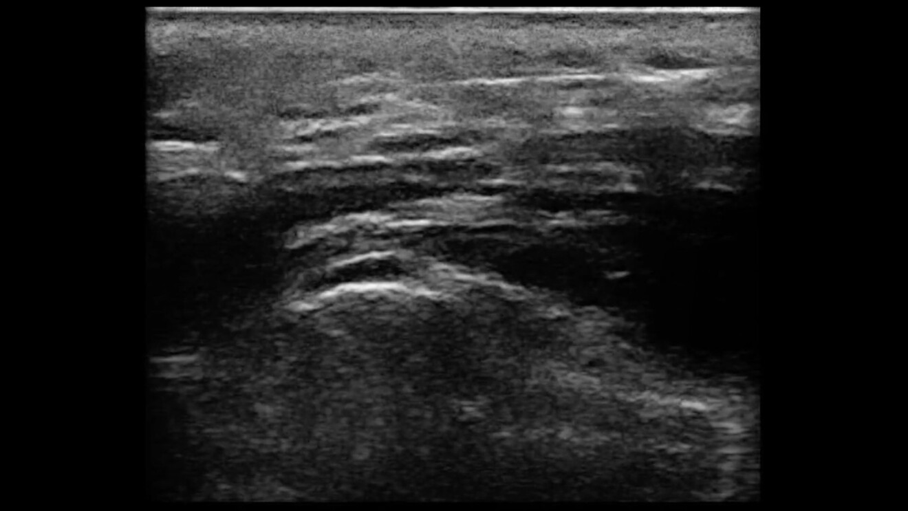 Fig. 8 - La guida ecografica consente di seguire il percorso del filo di biostimolazione o del filo di trazione.