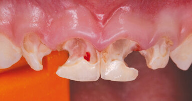 Využití CAD/CAM v pedostomatologii – kazuistika