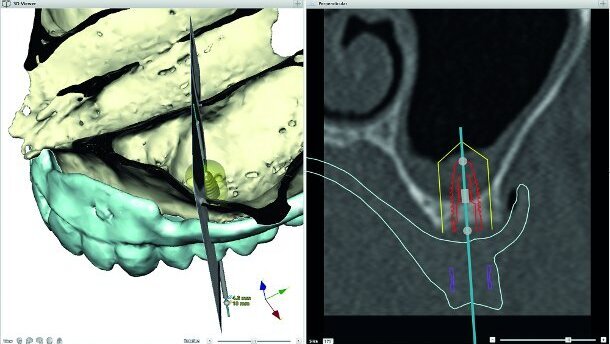 Digital possibilities for making implant prosthetics