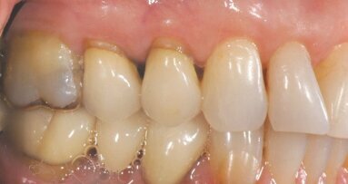 Using in-office CAD/CAM technology and lithium disilicate to fabricate efficient and predictable restorations