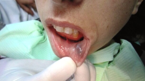 Leczenie naczyniowych schorzeń ust z zastosowaniem lasera