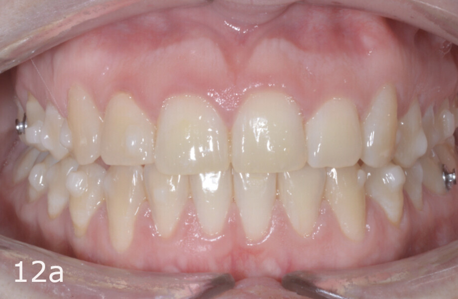 Figs. 12a–f: Situation after the second additional aligner set. Composite button on tooth #13 for use of triangular elastic to improve the vertical position of the tooth.