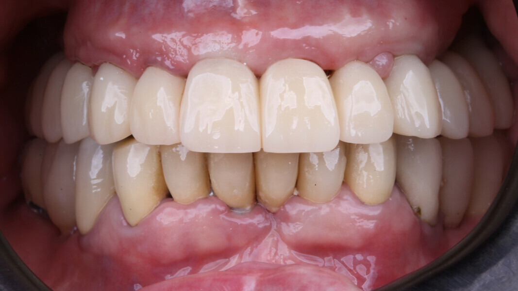 Fig. 16: PMMA prototype to test function and aesthetics.