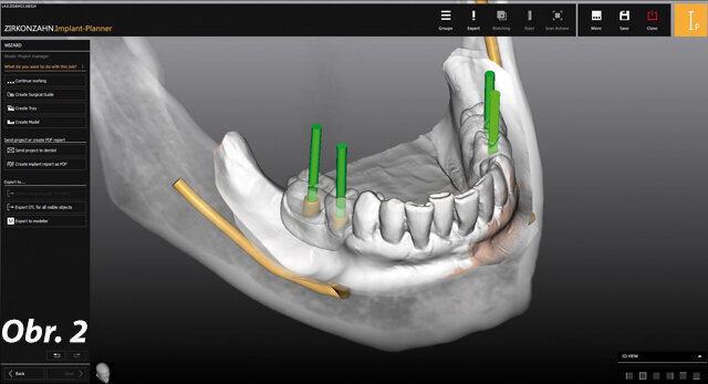 Naplánované titanové báze jsou zde pod semitransparentně zobrazenými zuby a gingivou dobře viditelné.