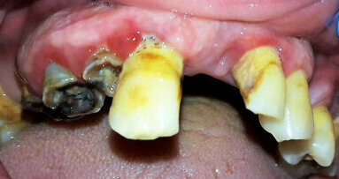 L’igienista dentale e il paziente diabetico: Motivazione e istruzioni di igiene orale