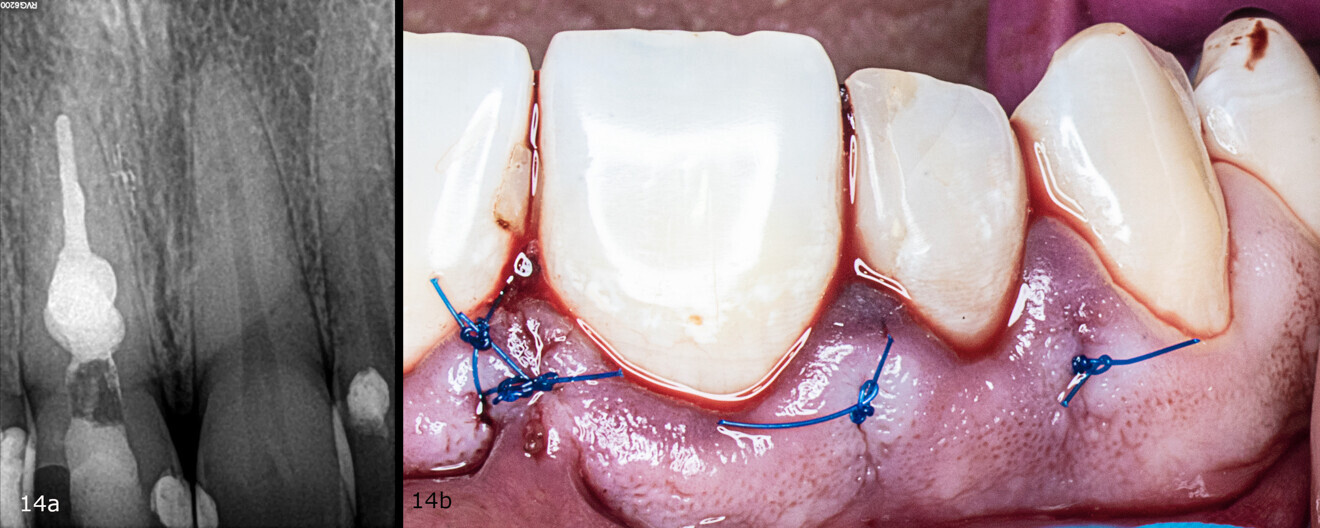 Figs. 14a & b: Radiograph taken after obturation (a). Clinical situation after suturing (b).