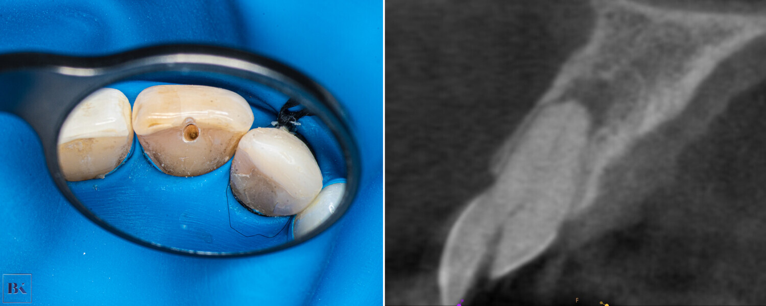 Figs. 6a & b: First stage of the access cavity creation (a). CBCT check, sagittal plane (b). The axis of the access cavity was visible.