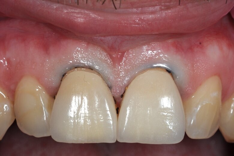 Fig. 12 Checking the fit of the veneers.