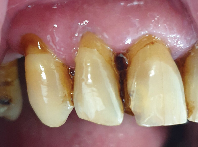 Sl. 2.3: Pacijent B, kontrola nakon 2 meseca pušenja cigareta