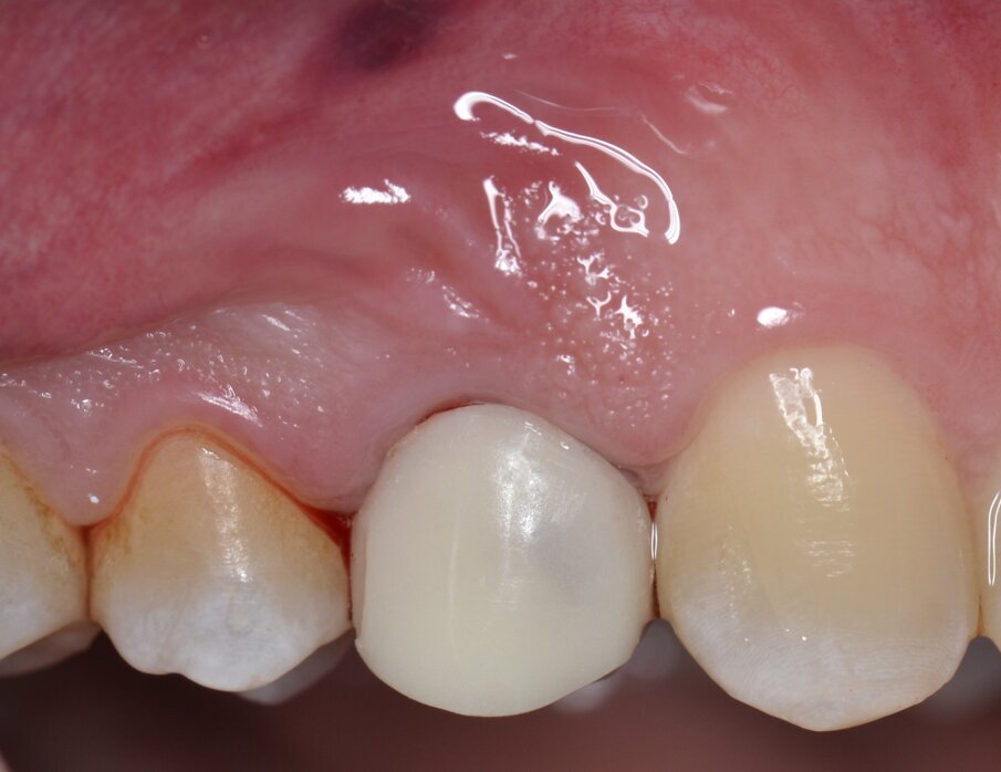 Fig. 16 - Corona provvisoria in resina ribasata sul moncone provvisorio (visione buccale).
