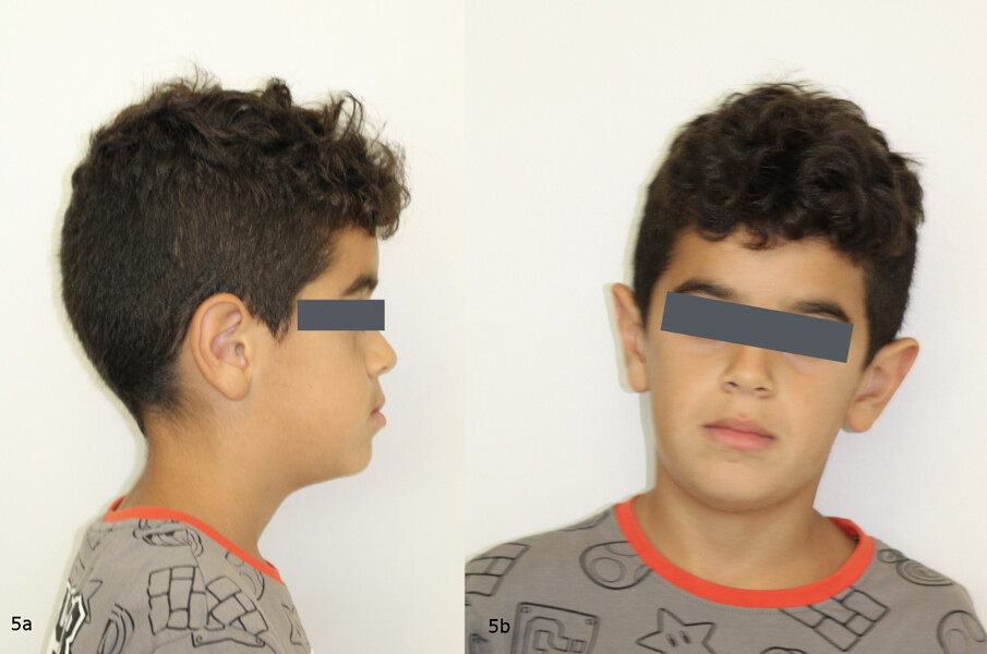  Figs. 5a & b: Facial photographs at the beginning of treatment: profile view (a); frontal view (b).