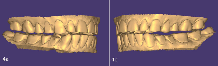 Obr. 4a–f: Návrh laterálních dostaveb v programu exocad.