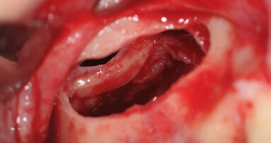 Rialzo di seno mascellare mediante utilizzo di osso eterologo corticomidollare collagenato