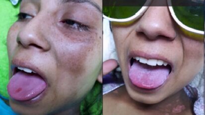 Perfil de pacientes oncológicos tratados con láser de baja intensidad