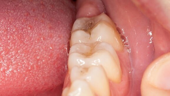 Диагностиката на слюнката може да промени денталната медицина