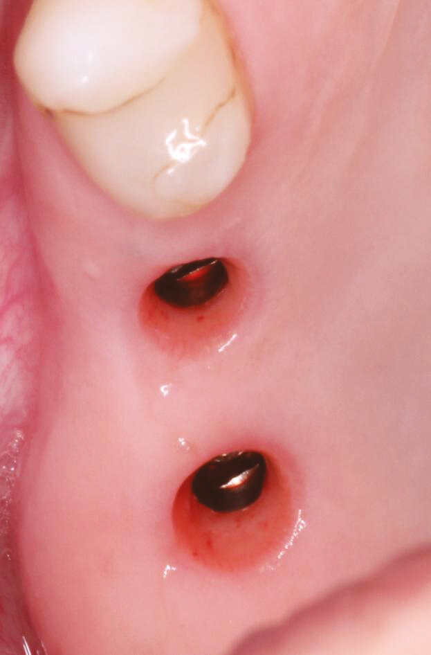 Fig.12: Heal check and Healing cap removal – note the proper tissue emergence profile and excellent health.