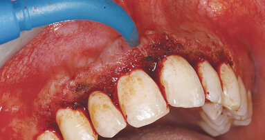 Estetika parodontu s využitím laserů na měkké tkáně