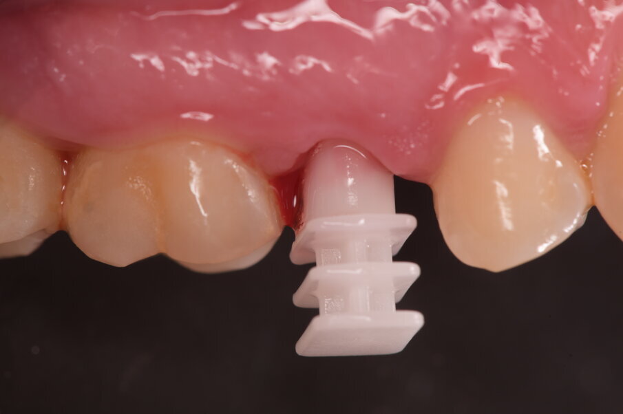 Fig. 8_La presa d’impronta determina uno stacco dalla procedura digitale, se il tragitto transmucoso è troppo profondo è meglio passare a un’impronta analogica convenzionale adottando il transfer specifico relativo alla lunghezza del moncone e al diametro dell’impianto.