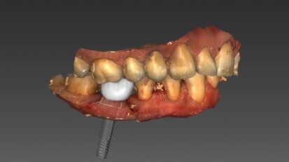 Cyfrowe techniki projektowania w estetycznych ostatecznych uzupełnieniach implantoprotetycznych