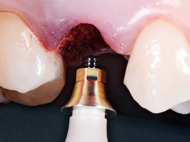 Nobel Biocare Services AG, s laskavým svolením dr. Giacoma Fabbriho