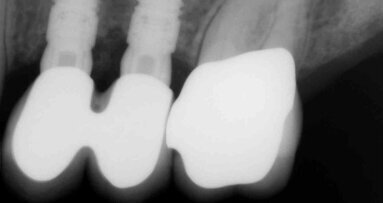 Simplified Apposition Technique, case series