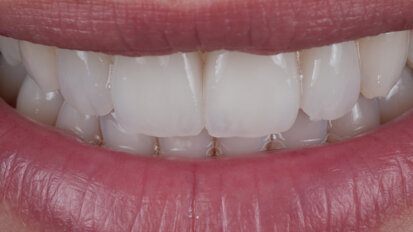 Struttura superficiale: Utilizzo di linee orizzontali e verticali per simulare l’aspetto naturale del dente – Teoria e procedura tecnica