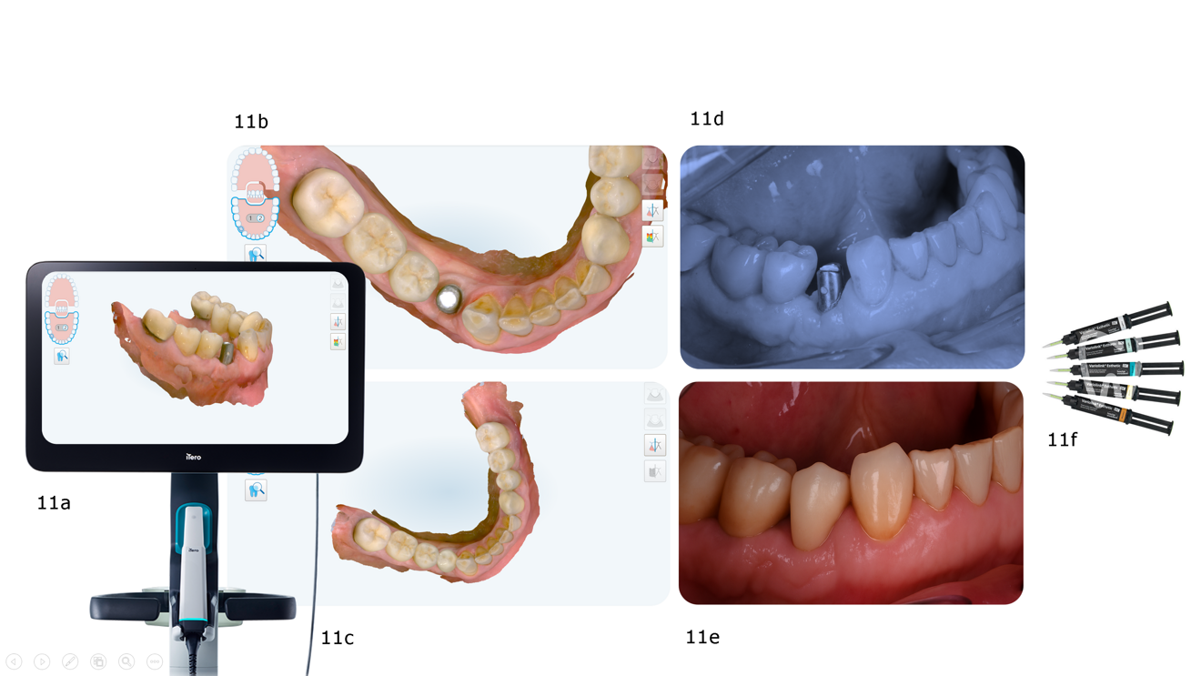 Figs. 11a–f: Delivery of the definitive 3D-printed hybrid composite restoration, cemented on to the individual titanium hybrid abutment. Intra-oral scans illustrating the prepared site, neighbouring dentition and emergence profile (a–c). Buccal view of the titanium hybrid abutment in situ (d). Buccal view of the definitive 3D-printed restoration after cementation (e). Variolink Esthetic DC resin cement used for luting (f).