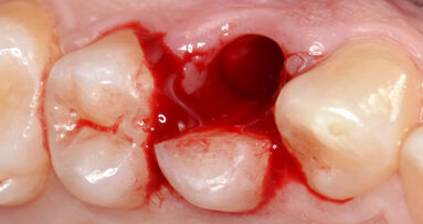 Riabilitazione di un sito monoedentulo con impianto postestrattivo a provvisorizzazione immediata