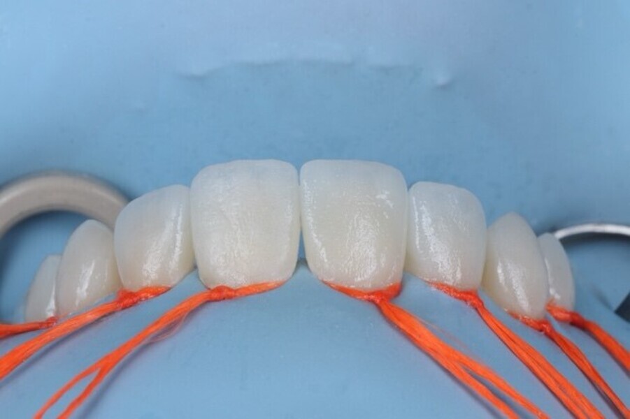 Fig. 3i: Build-up of enamel layer using beautifil ii enamel shade hvt (high value  translucent).