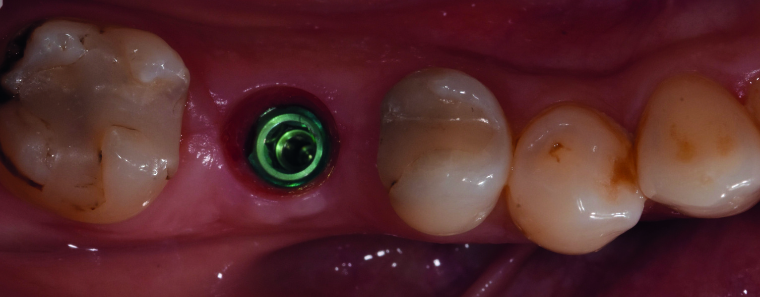 Fig. 19 : Cicatrisation tissulaire guidée par la vis de cicatrisation, notez la belle santé gingivale lors du dévissage du pilier de cicatrisation. 