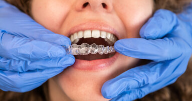 Aligners: More regulation or just a consumer product?