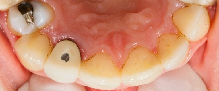 Fig. 4a - Fotografia del secondo sestante palatale al primo rilevo delle black stains. 