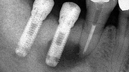 Periapikální léze implantátů a retrográdní periimplantitis – dva stavy nepříliš zdokumentované