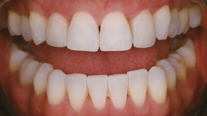 Optimising functional and aesthetic parameters in veneer cementation