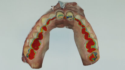Technologie digitálního otiskování v současné stomatologické praxi