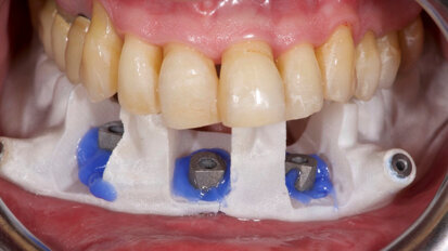 Extraoral digitalization: A digital protocol for surgical treatment of edentulous patients