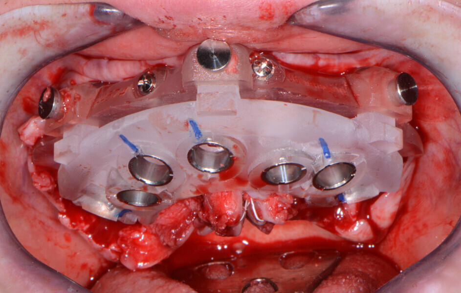 Fig. 8: Maxillary implant surgical guide.