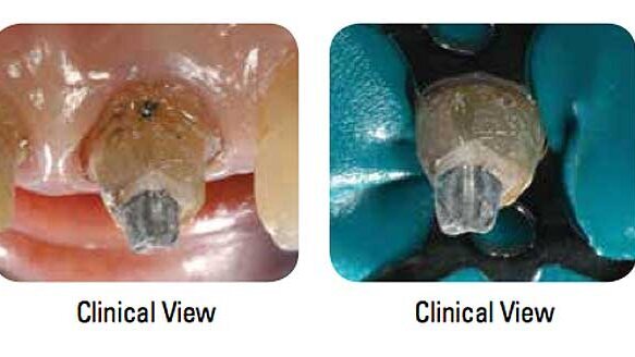 Enhanced clinical guide helps dentists save natural teeth