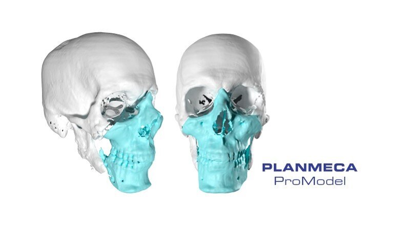 Second face transplant operation in Nordic countries performed in Finland