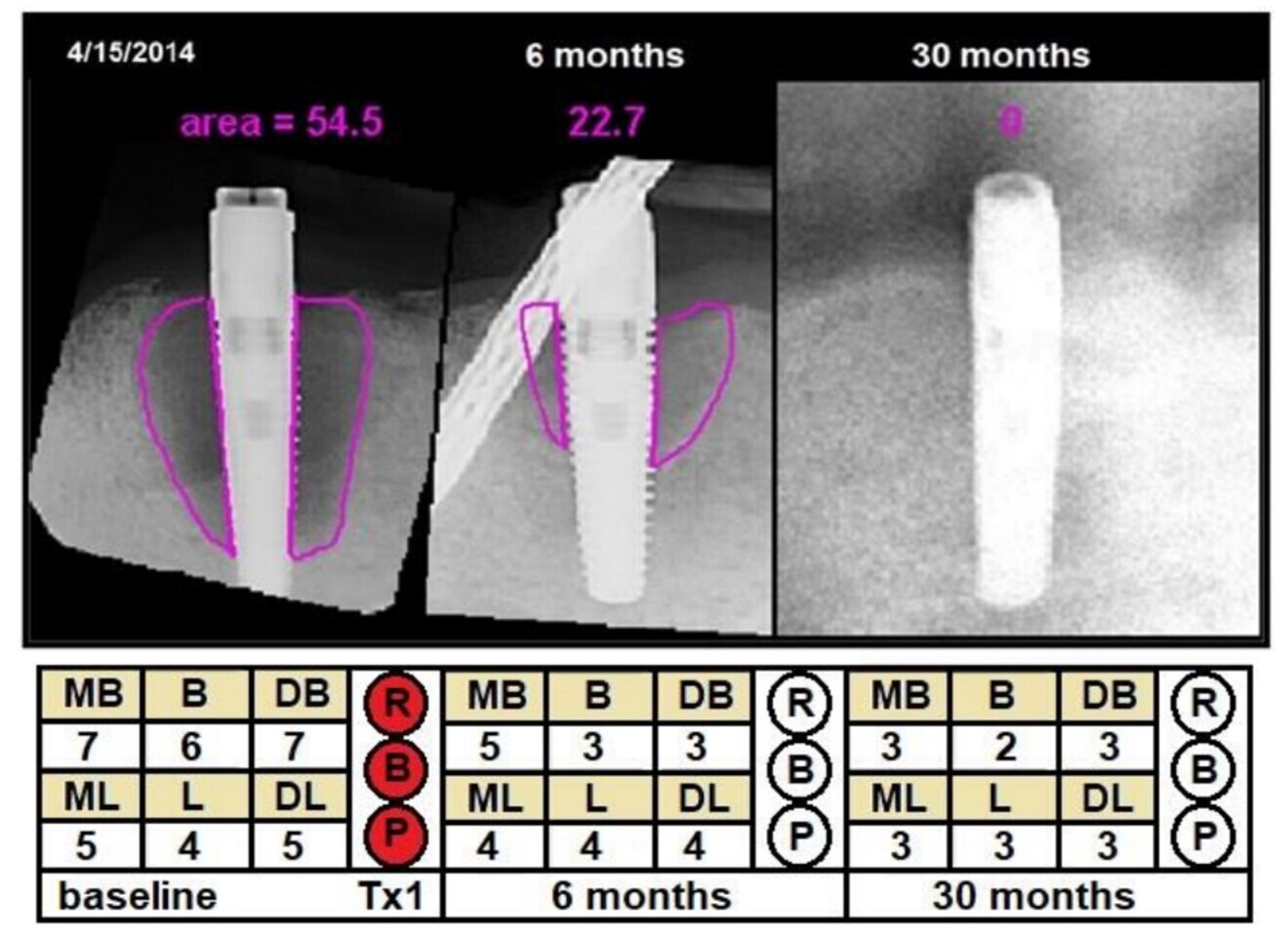 Fig. 2: Example of a successful treatment (Case 1), showing changes in radiographic defect (mm2), probing depth (PD; mm) and clinical signs from baseline to 30 months later. Violet = cross-sectional area; MB = mesiobuccal PD; B = buccal PD; DB = distobuccal PD; ML = mesiolingual PD; L = lingual PD; DL = distolingual PD; R = redness; B = bleeding; P = suppuration; Tx1 = first treatment.